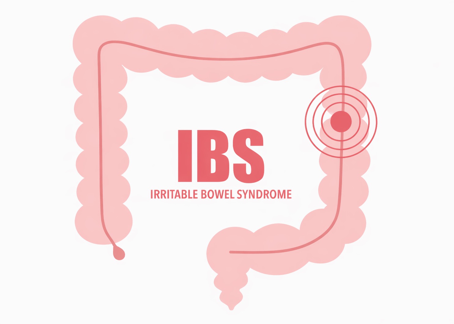 過敏性腸症候群（IBS）とは